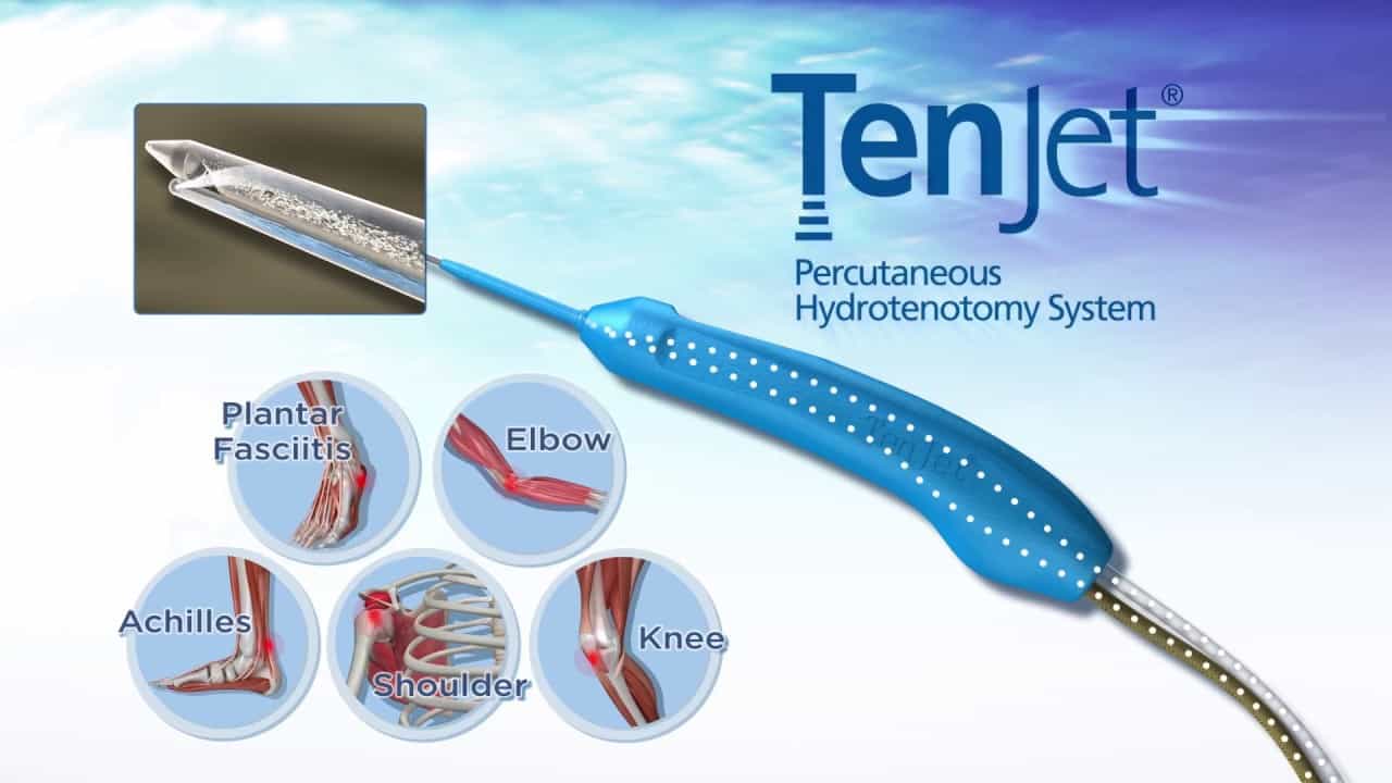 TenJet for tendinopathy